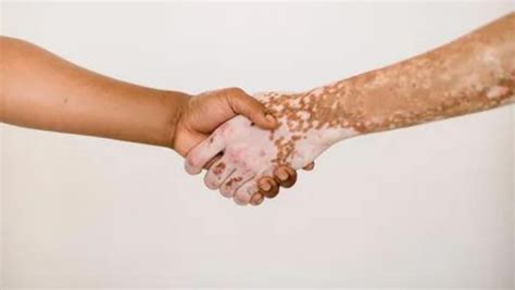 vitiligo hastalığına iyi gelen yiyecekler